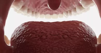 Base of Tongue Cancer