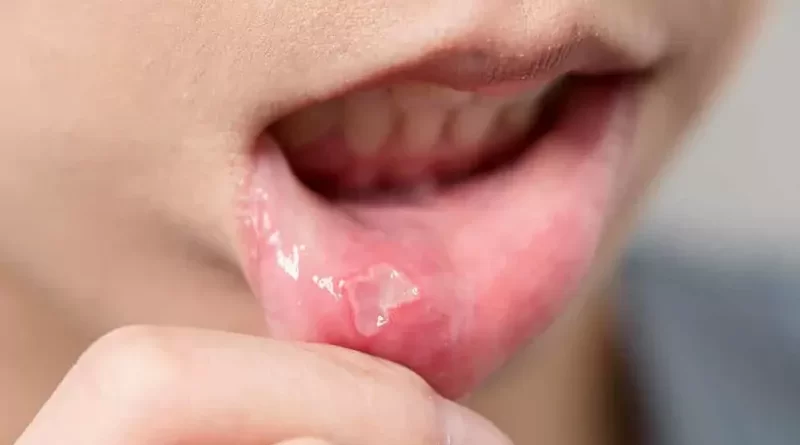 Canker Sores