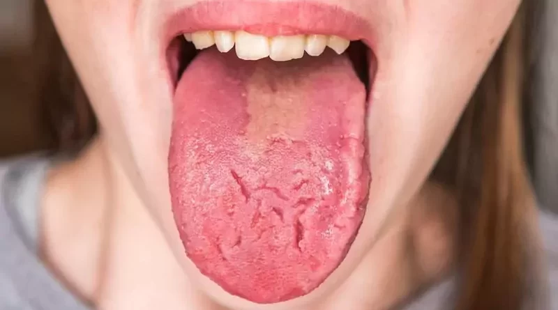 Fissured Tongue