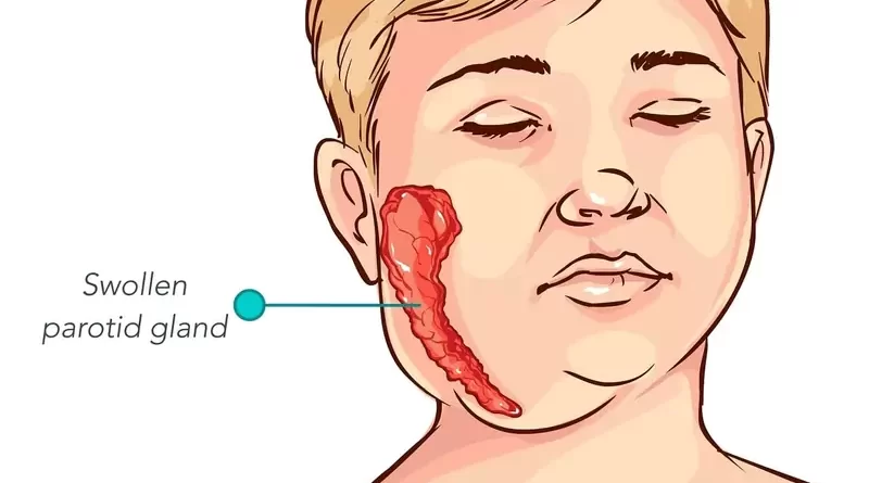 Parotid Gland Cancer