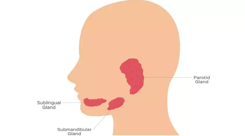 Sublingual Gland Cancer