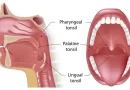 Tonsil Cancer
