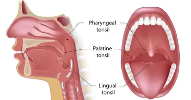Tonsil Cancer