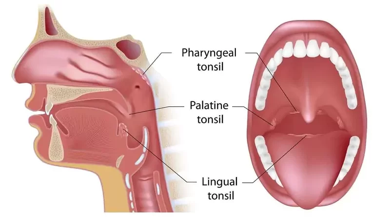 Tonsil Cancer